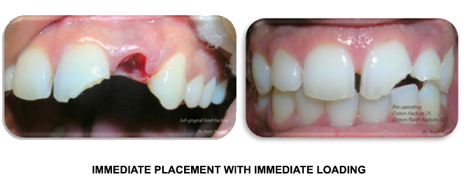 dental-implant